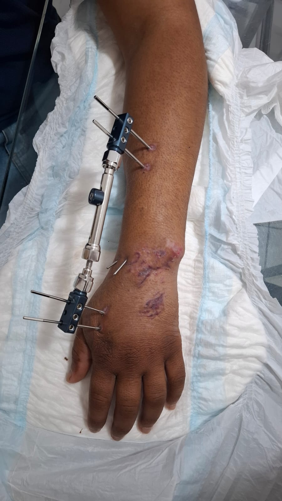 Depois do tratamento de ferida no braço